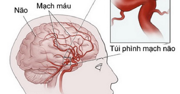 Phình mạch não là gì? Dấu hiệu nhận biết