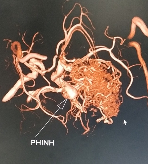 Phình mạch não là gì? Dấu hiệu nhận biết