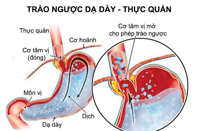 Phòng ngừa chứng trào ngược dạ dày thực quản