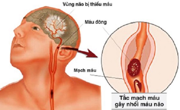 Phòng ngừa đột quỵ để ngăn ngừa nguy cơ tử vong