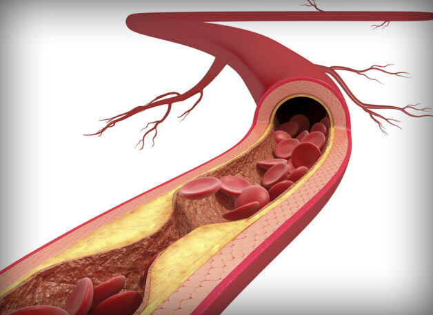 Phòng ngừa đột quỵ não do xơ vữa động mạch