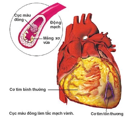 Phòng ngừa nhồi máu cơ tim ở người trẻ