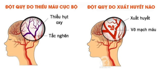 Phòng tránh và điều trị đột quỵ não đúng cách giúp giảm rủi ro