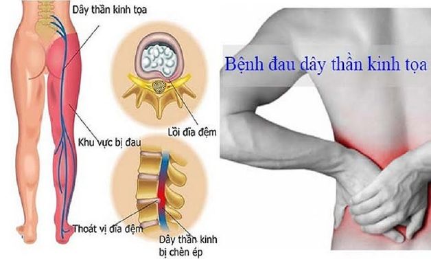 Phòng và điều trị đau thần kinh tọa như thế nào?