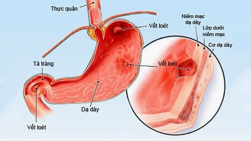 Phù nề dạ dày nên ăn gì thì mới an toàn cho sức khỏe