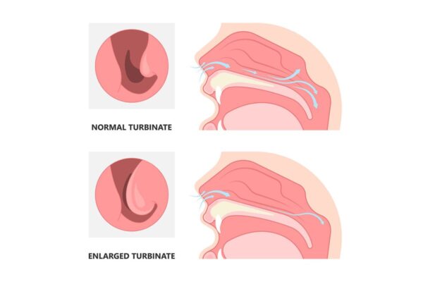 Phù nề niêm mạc mũi là biểu hiện của bệnh gì?