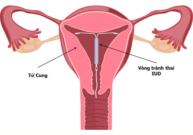 Phụ nữ đặt vòng có bị tăng cân không?