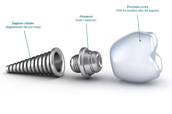 Phương pháp cấy ghép implant phù hợp với đối tượng nào?