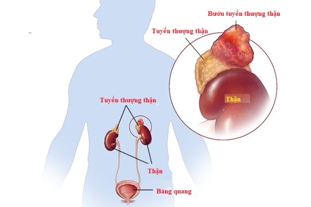 Phương pháp chẩn đoán hình ảnh u tuyến thượng thận phổ biến