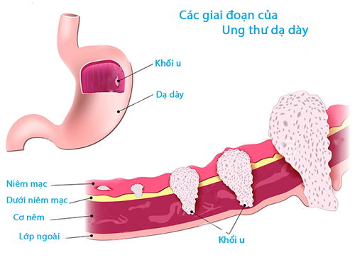 Phương pháp chữa ung thư dạ dày