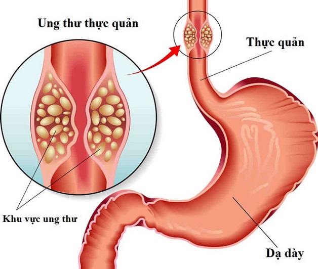 Phương pháp chụp chiếu và xét nghiệm ung thư thực quản