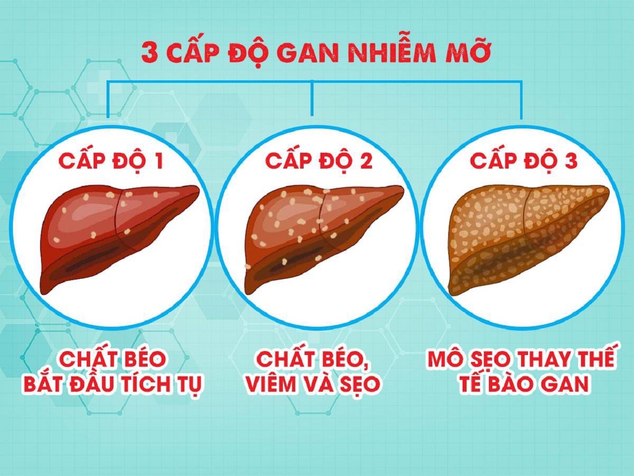 Phương pháp điều trị gan nhiễm mỡ độ 1 cực hiệu quả