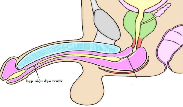 Phương pháp điều trị sỏi tiết niệu đối với sỏi niệu đạo trước