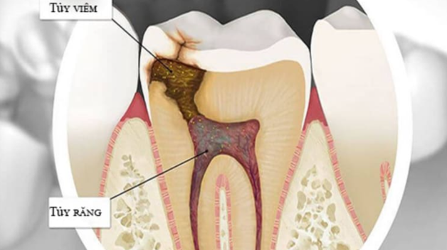 Phương pháp điều trị tủy răng khi mang thai