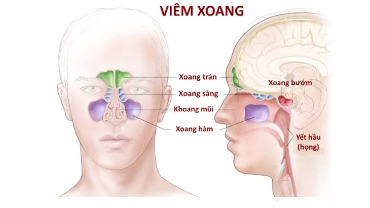 Phương pháp điều trị viêm xoang sàng phổ biến hiện nay