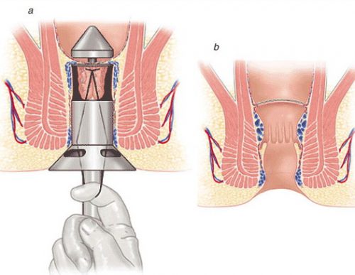 Phương pháp mổ trĩ hiện đại hiện nay
