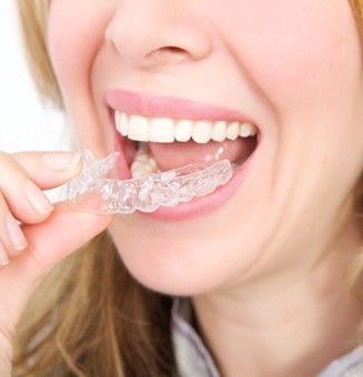 Phương pháp niềng răng Invisalign có đem lại hiệu quả?