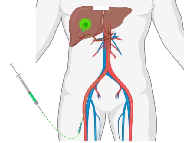 Phương pháp nút mạch trong điều trị ung thư gan