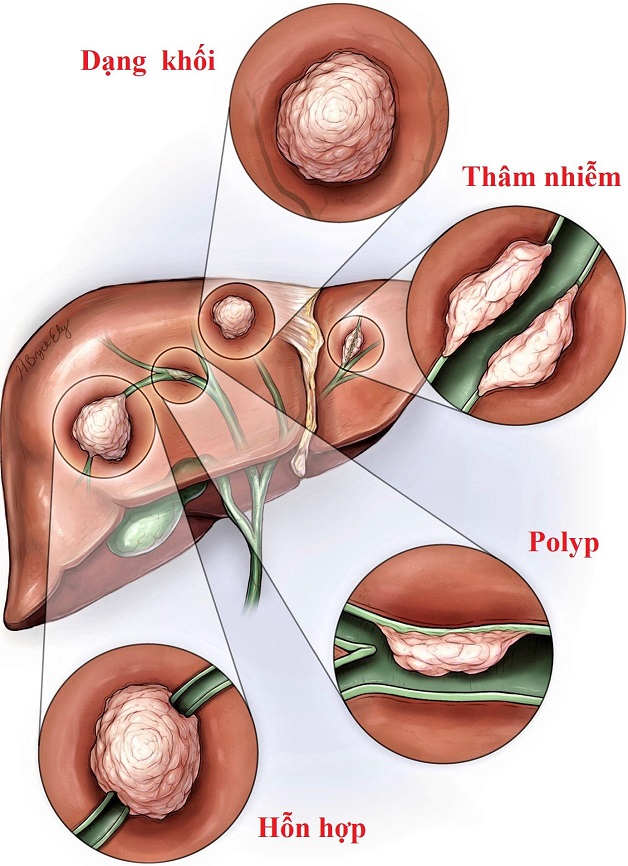 Phương pháp phẫu thuật ung thư đường mật trong điều trị