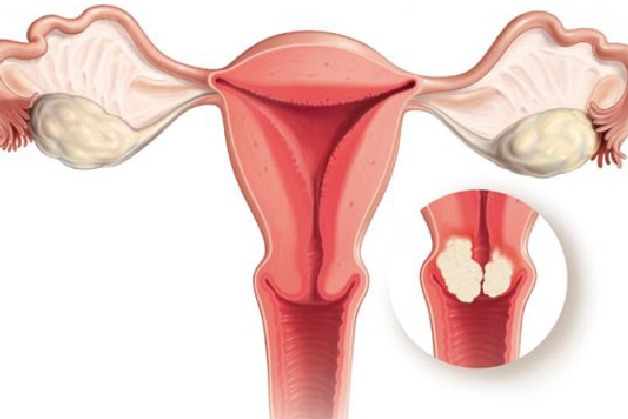 Phương pháp tầm soát ung thư cổ tử cung HPV chị em cần biết