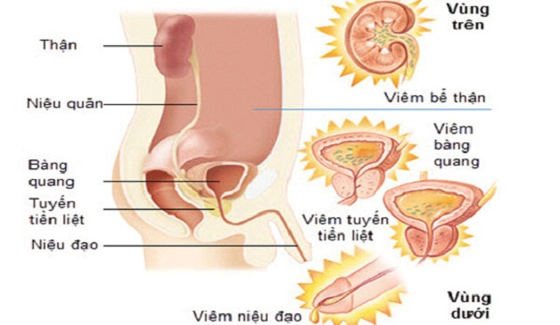 Phương pháp tối ưu điều trị viêm tiết niệu nam giới hiện nay