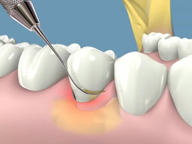 Phương pháp xử lý cao răng sữa cho trẻ hiệu quả