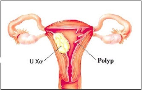 Polyp buồng tử cung và những điều cần biết