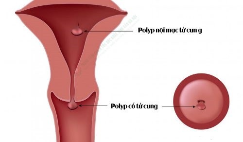 Polyp cổ tử cung khi mang thai có sao không?