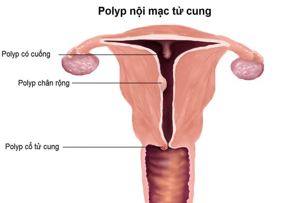 Polyp cổ tử cung khi mang thai: những điều mẹ bầu nên biết