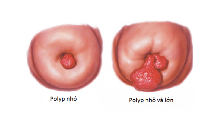 Polyp cổ tử cung: Nguyên nhân, triệu chứng và điều trị