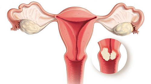 Polyp cổ tử cung và những điều cần biết