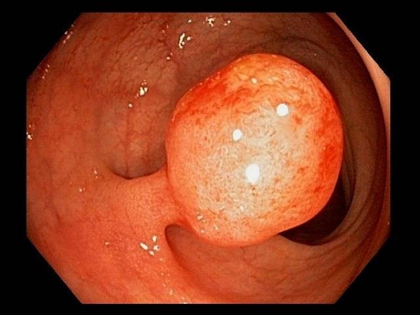 Polyp dạ dày có chuyển thành ung thư không?