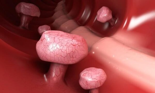 Polyp đại tràng chảy máu cảnh báo về dấu hiệu nguy hiểm