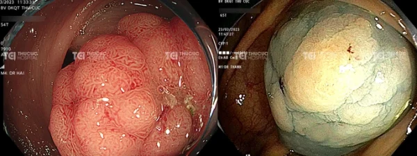 Polyp đại tràng chảy máu cảnh báo về dấu hiệu nguy hiểm