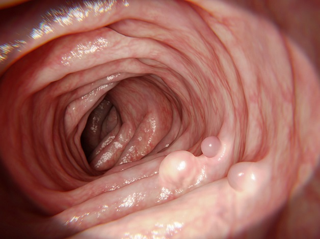 Polyp đại tràng có gây ung thư không? Chẩn đoán và điều trị