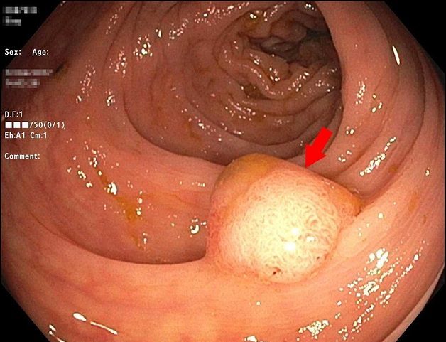 Polyp đại tràng là gì? Có phải là ung thư đại tràng không?