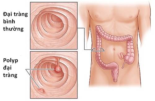 Polyp đại tràng là gì? Polyp đại tràng có gây ung thư?