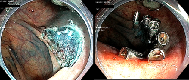 Polyp đại tràng nghịch sản độ cao có phải ung thư không?