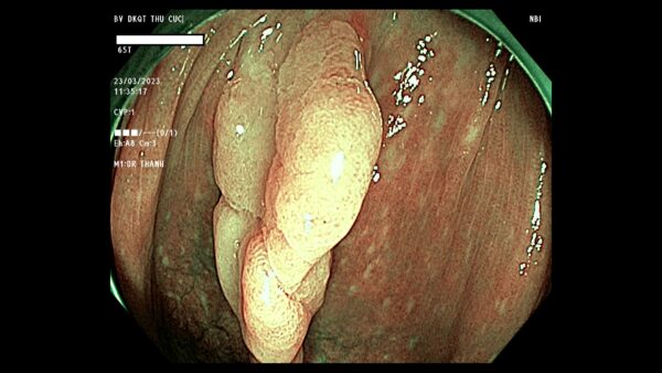 Polyp đại tràng ra máu có nguy hiểm không, xử lý như thế nào?