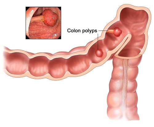 Polyp đại tràng và những điều cần biết polyp đại tràng