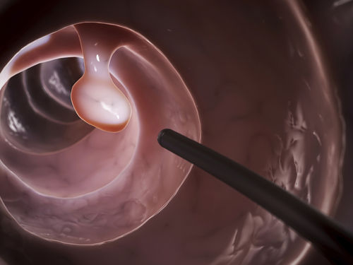 Polyp đại trực tràng khi nào cần cắt bỏ?