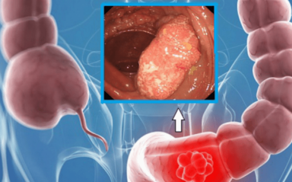 Polyp đại trực tràng khi nào cần cắt bỏ?