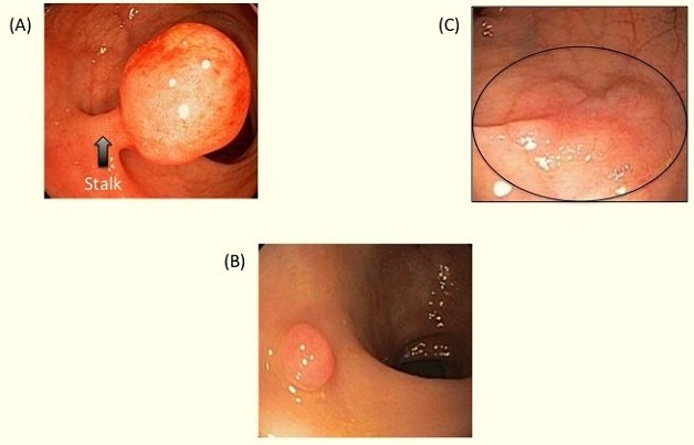 Polyp đại trực tràng và những điều cần biết