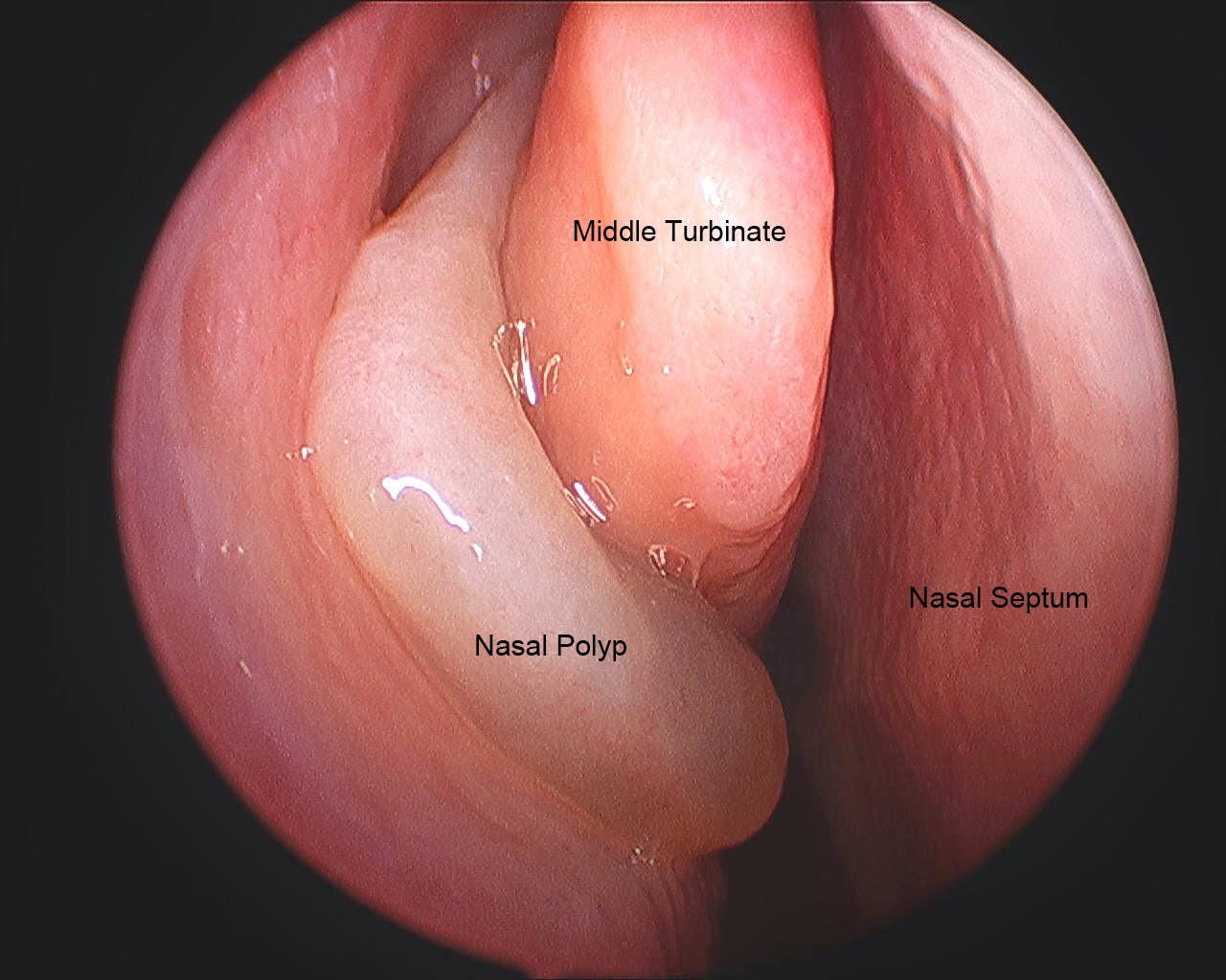 Polyp họng là gì? gây ra một số triệu chứng khó chịu