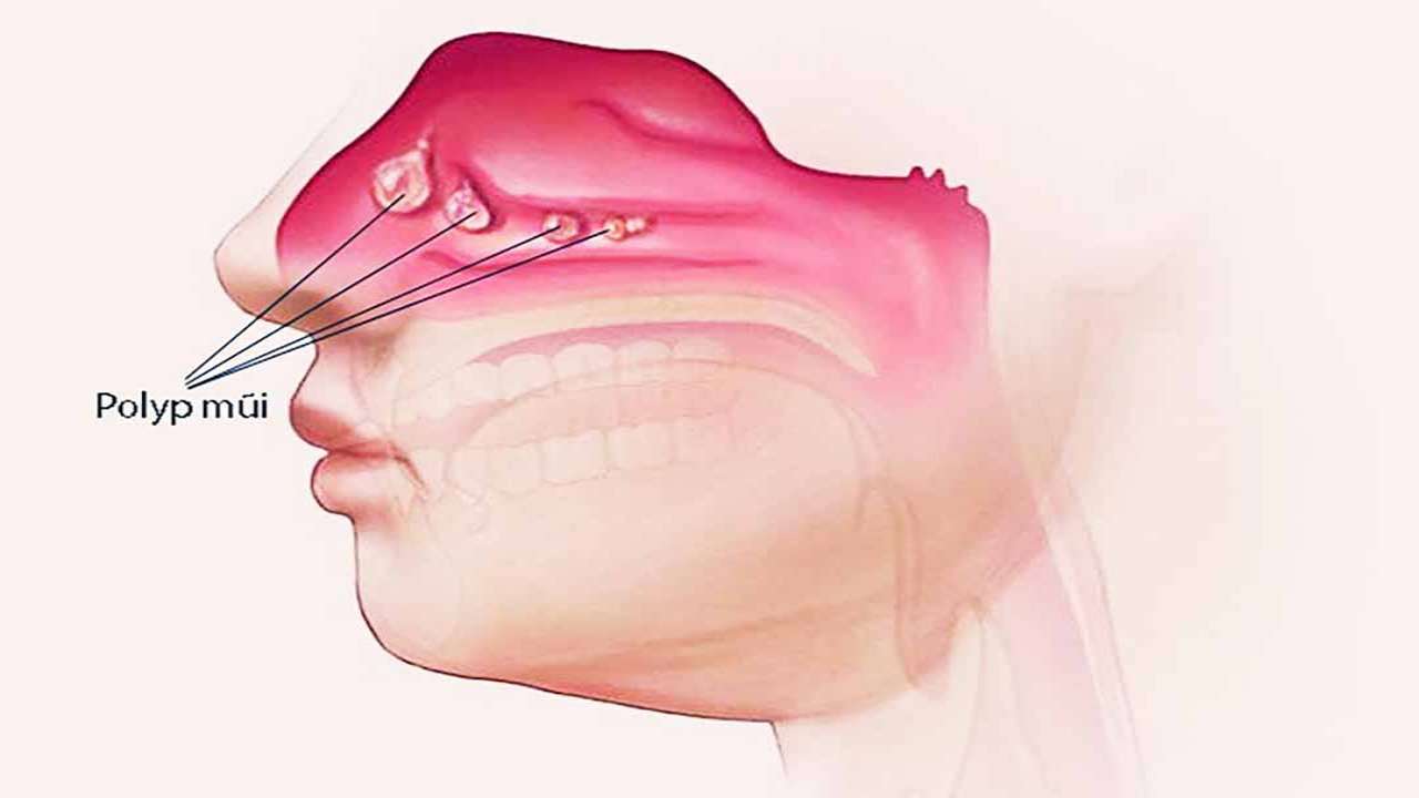 Polyp mũi có tự hết không? Nếu không hết phải làm sao?