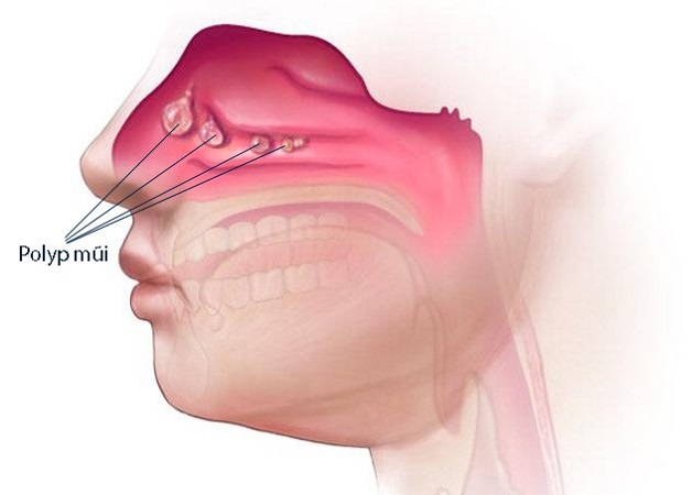 Polyp mũi có tự hết không? Nếu không hết phải làm sao?