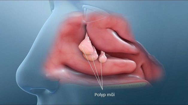 Polyp mũi là bệnh gì? Nguyên nhân và cách điều trị ra sao?