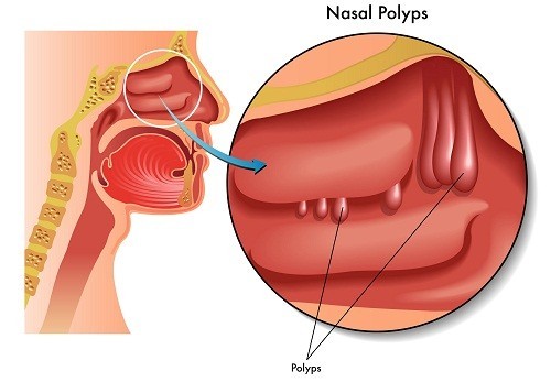 Polyp mũi và những điều bạn cần biết