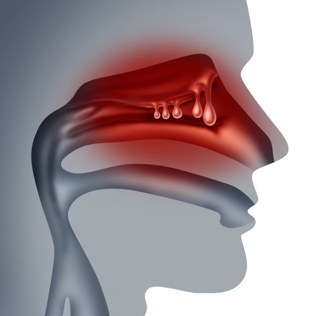 Polyp mũi xoang là bệnh gì? Làm sao để điều trị hiệu quả?