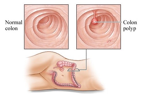 Polyp trực tràng có nguy hiểm không?